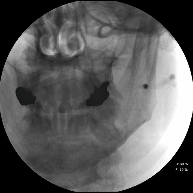 some retained contrast in abnormally large (post-obstructive dilation) duct lemon gtss