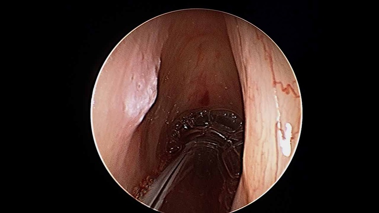 Intraoperative - resection of left vocal fold leukoplakia