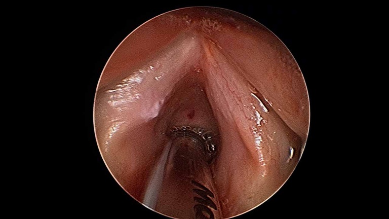 Intraoperative - resection of left vocal fold leukoplakia