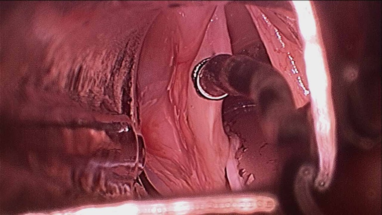 Intraoperative - resection of left vocal fold leukoplakia