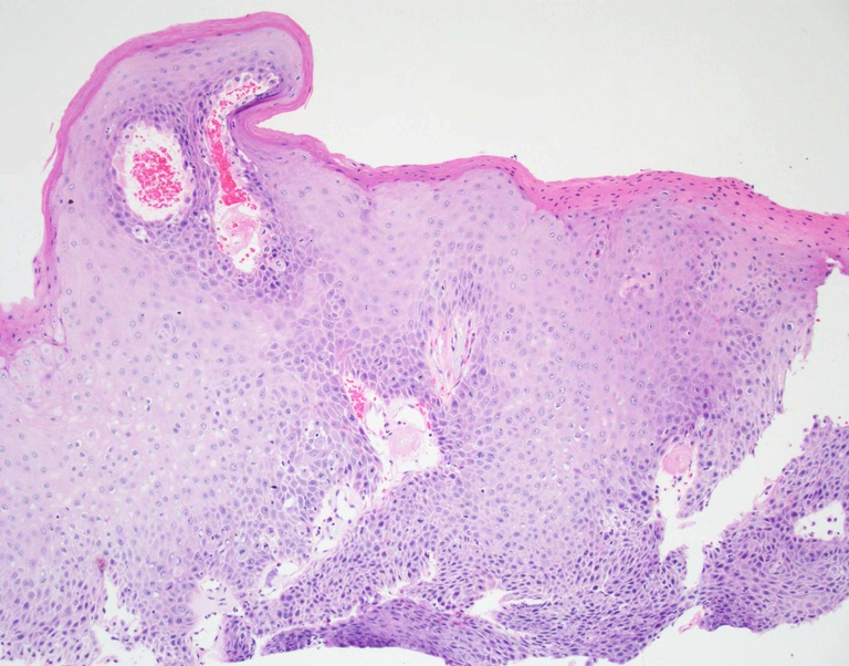 Biopsy from anterodorsal portion of the right vocal cord showing cytologic atypia extending into the middle third of the mucosa with increased and mid-level mitoses, sufficient for a diagnosis of moderate squamous dysplasia.