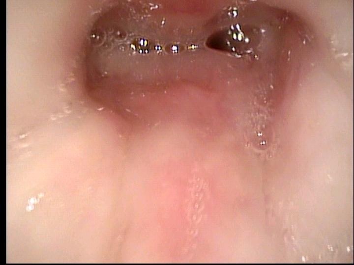 10-21-10 transnasal fiberoptic view between the vocal cords of subglottis