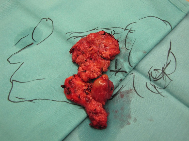 08%20parotid.jpg