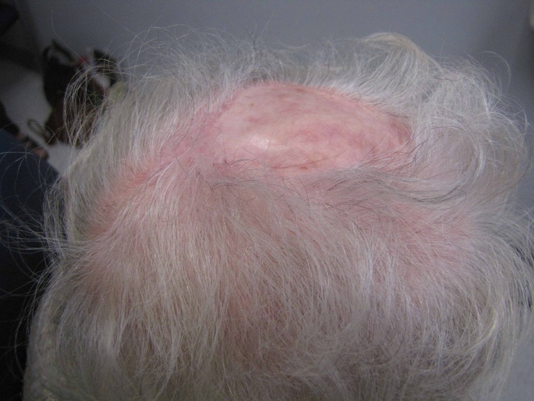 082 6 mo postop scalp.jpg