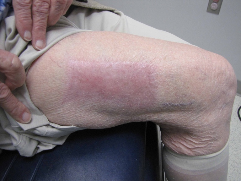 083 6 mo postop leg.jpg