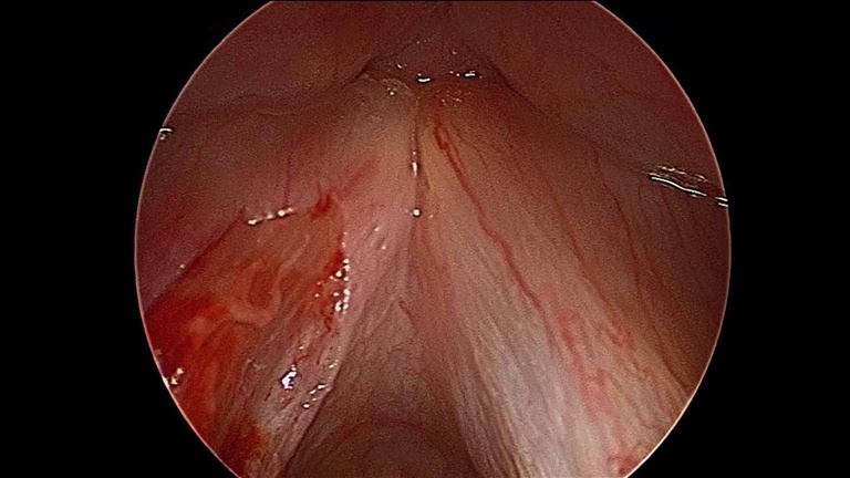 Intraoperative - resection of left vocal fold leukoplakia