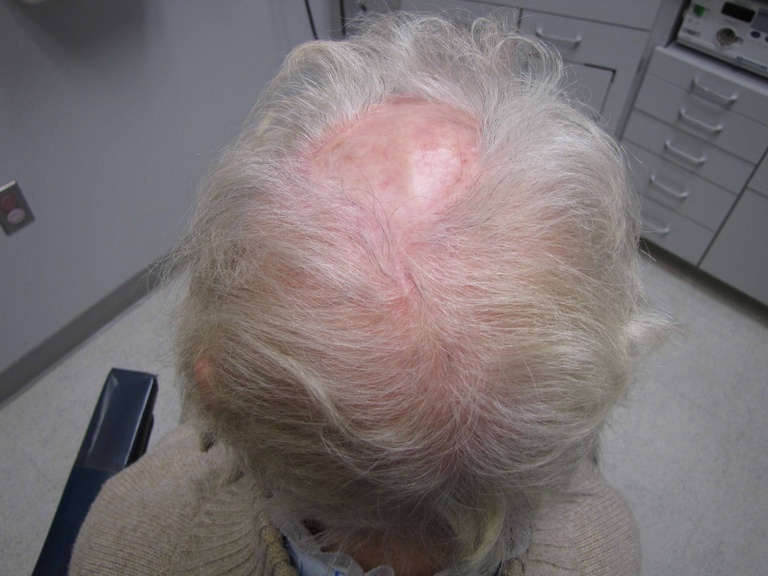 084 6 mo postop scalp.jpg