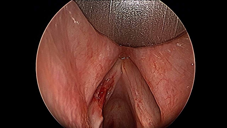 Intraoperative - resection of left vocal fold leukoplakia