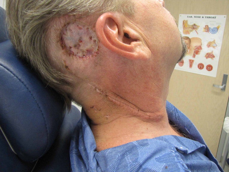 Post-op day 10 after skin graft and posterolateral neck dissection