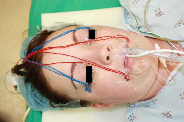 Bilateral NIMS electrodes