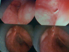 01 direct laryngoscopy showing fistula from apex of pyriform sinus