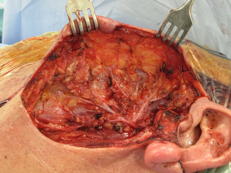 10%20parotid.jpg