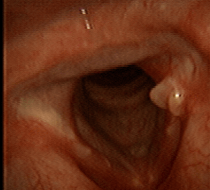 March 2007 Voice normal, granuloma present