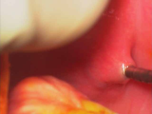 dilation of left parotid duct over 0.018 in microangio guide wire