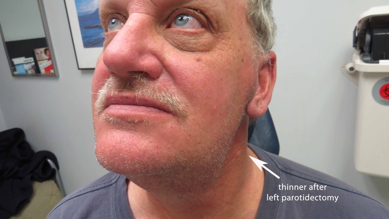 4 1/2 months after parotidectomy