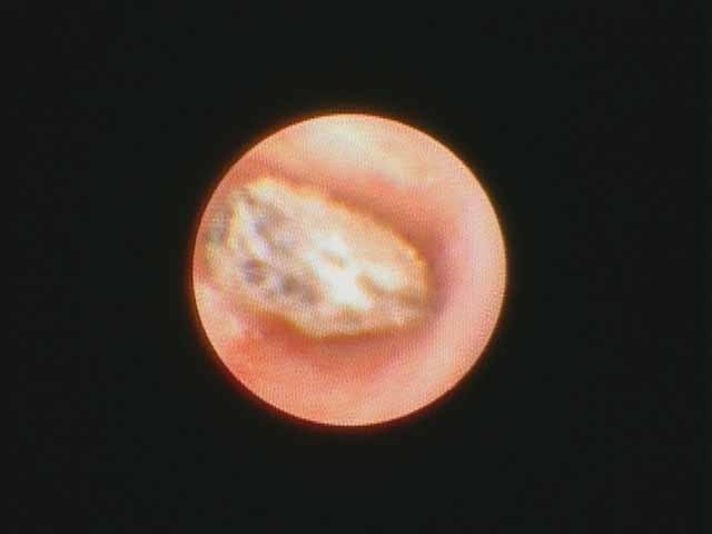 metallic foreign body visualized in duct via sialendoscopy
