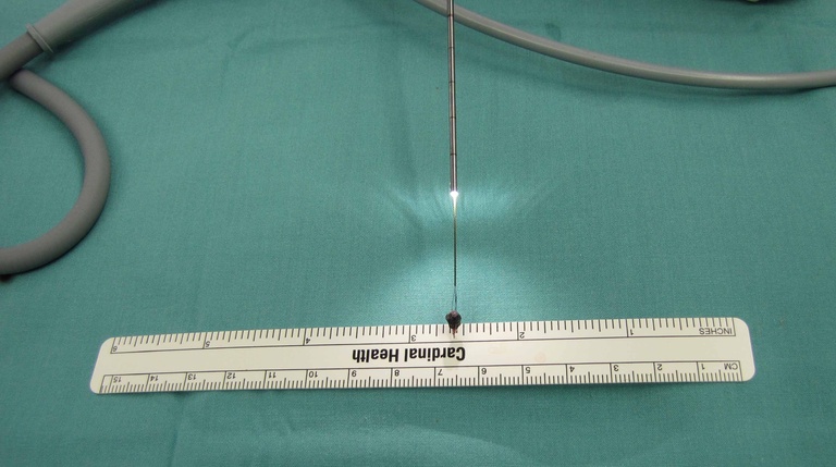 metallic foreign body removed with basket (still inside illumated sialendoscope)
