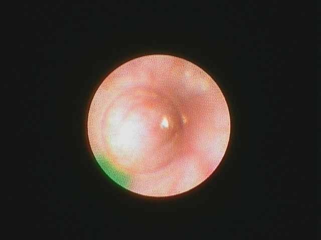 clear lumen confirmed with sialendoscope at end of case through stent prior to kenalog placement