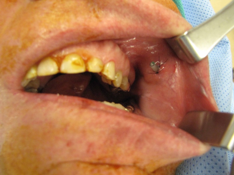 stent (8 Fr pediatric nasogastric feeding tube trimmed at both ends) secured with two 6-0 nylon sutures