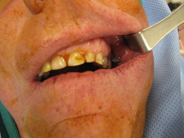 view of stent at end of case