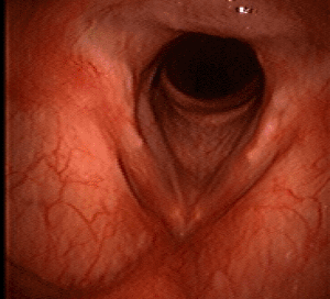 Nov 2009 Voice normal, no evidence for granuloma