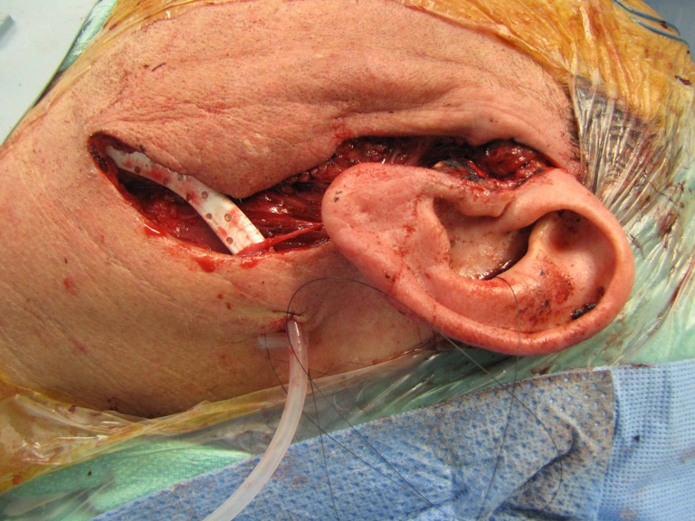 13%20parotid.jpg