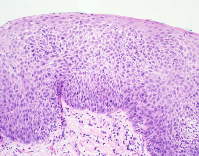 Biopsy from the anterior right vocal cord shows full-thickness severe cytoarchitecture disorder with marked nuclear pleomorphism and hyperchromasia; no invasion was present.