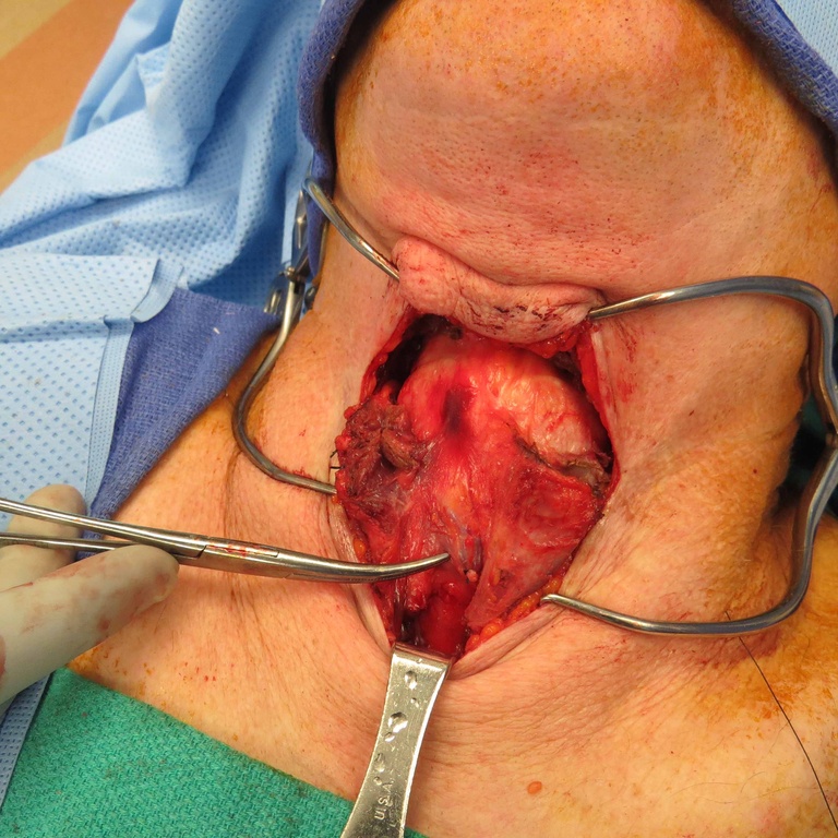 2013 May supracricoid laryngectomy with partial right arytenoid resection