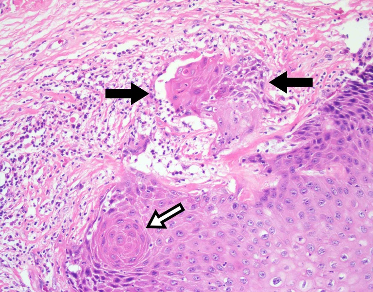 Intermediate magnification of designated area showing an irregular, invasive nest (black arrows) in the superficial submucosa and a deep keratin pearl (white arrow).
