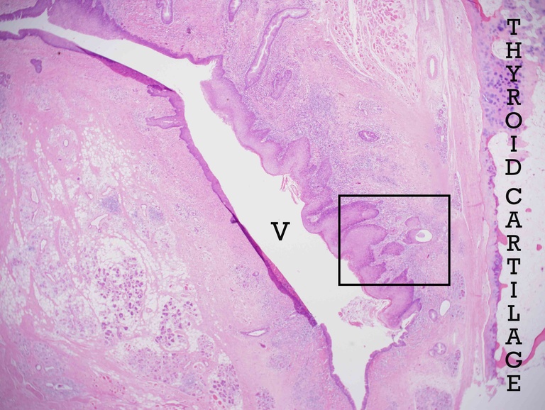 Low magnification of another area of the supracricoid laryngectomy with thyroid cartilage (right), ventricle (V), and a focus of invasive carcinoma arising in obviously atypical mucosa (black box) which is magnified in the next photomicrograph.