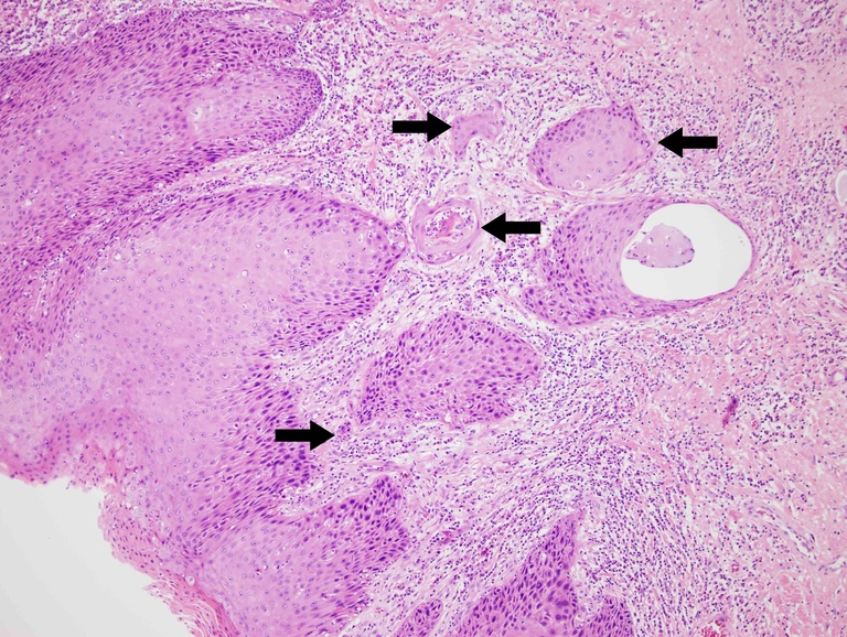 Intermediate magnification of boxed area showing infiltrating, irregular nests (black arrows) extending into the superficial submucosa (<0.1 cm depth of invasion).