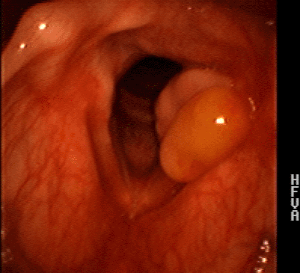 2005 Referral to UIHC recurrent dysphonia Aug 2005