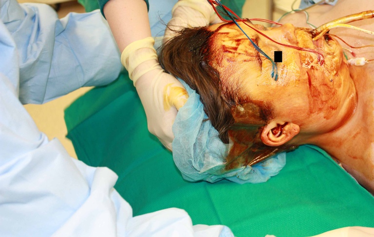Sterile towel under head
