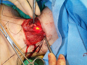  02 transillumination of pyriform sinus seen in neck   