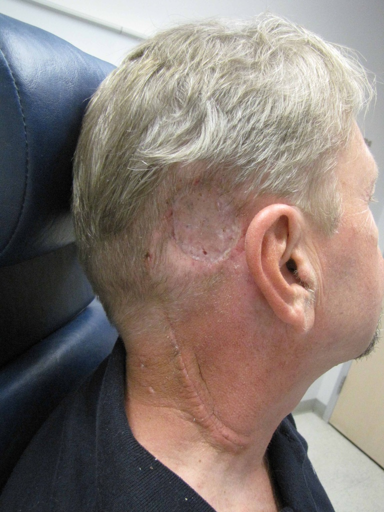 Post-op day 25 after skin graft and posterolateral neck dissection