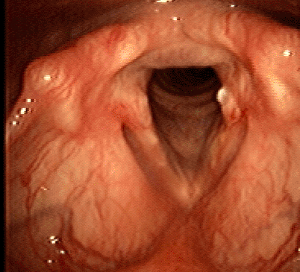 Recurrence after resection kenalog injection March 2006