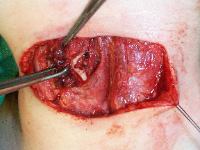 04 defect created in thyroid cartilage similar to arytenoid adduction approach