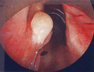 August 2006 laryngoscopy resection with botox 15 units left TA