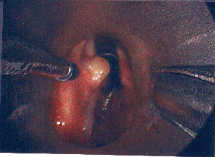 August 2006 laryngoscopy resection with botox 15 units left TA
