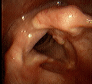 Sept 2006 4 weeks postop breathy voice