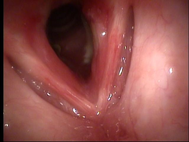 Transnasal fiberoptic laryngoscopy at UIHC 08/17/10 (day 8 of prednisone)