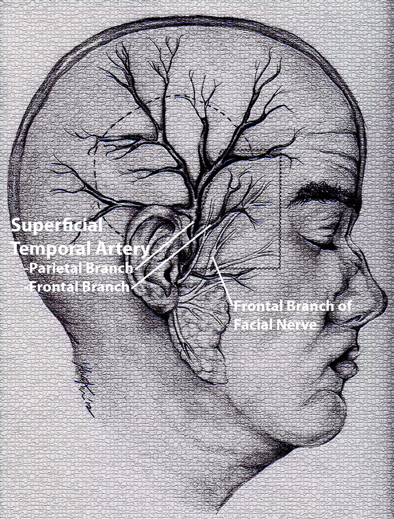 Illustration Courtesy of Marie KimDanger Zone delineated by dotted box showing proximity of frontal branch of facial nerve to the frontal branch of superficial temporal artery.