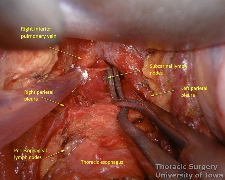 Subcarinal lymph nodes are resected under direct vision during esophagectomy