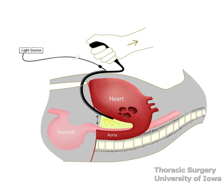 Arshava transhiatal retractor designed for comfortable retraction and improved visualization in the posterior mediastinum during esophagectomy.jpg