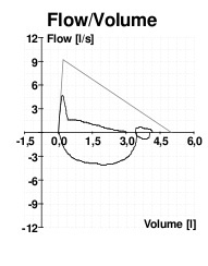 Flow volume loop in a patient with COPD demonstrating impaired inhalation.  Image obtained from http://commons.wikimedia.org/wiki/File:COPD.png.
