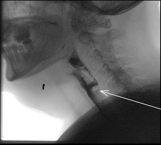 Cricopharyngeal bar seen on OPMS