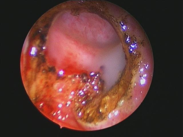 Cyst%20Marsupialized.JPG