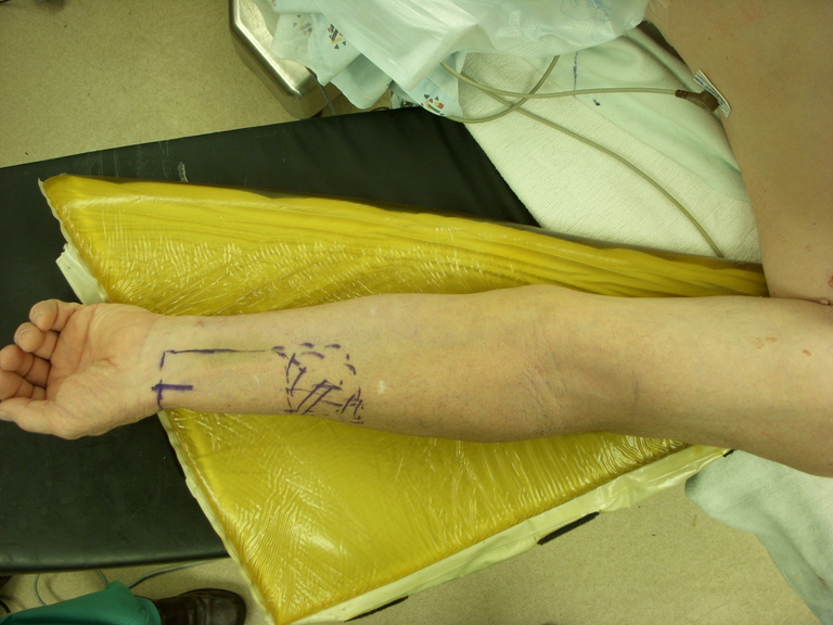 We routinely use two arm boards side by side and gel pads for additional padding.