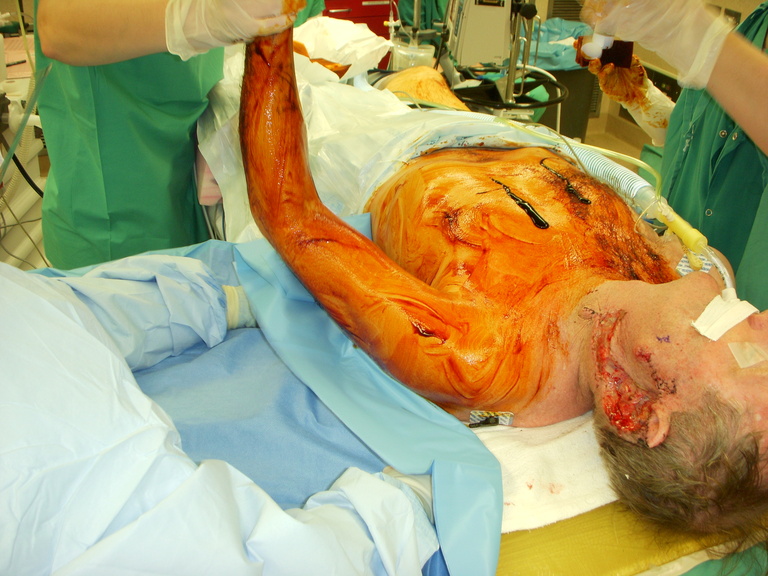 This patient underwent delayed reconstruction, with primary resection the week prior.