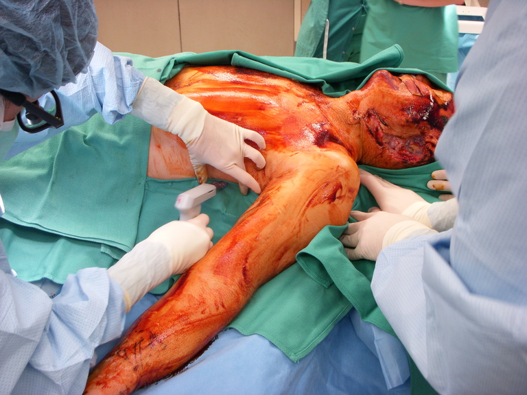 Securing the drapes with staples versus sutures is per attending surgeon preference.